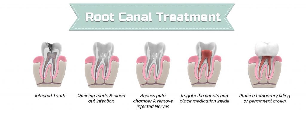 Root Canal Therapy and Treatment | Michelle Wang DDS